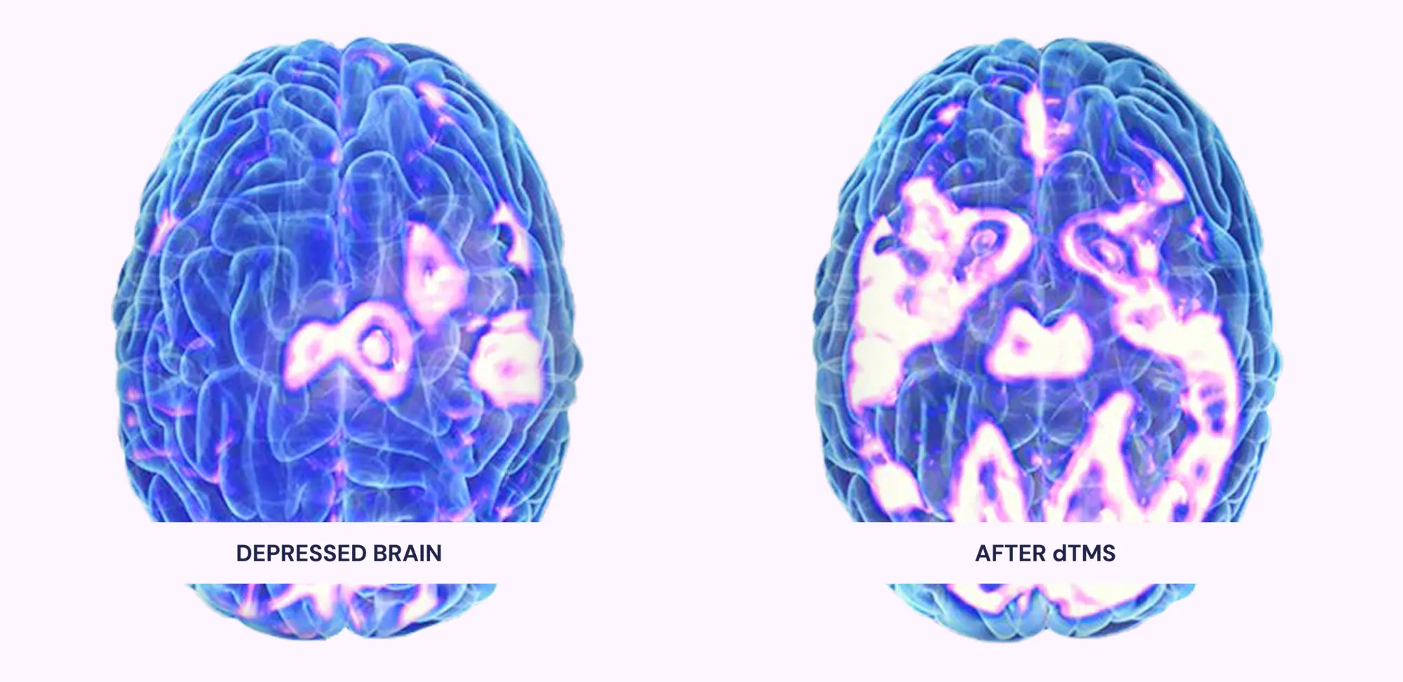 PET-style scan comparison: a depressed brain beside the same brain after deep TMS, showing restored activity